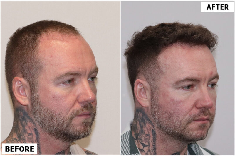 Hair transplant 1661 grafts FUE right
