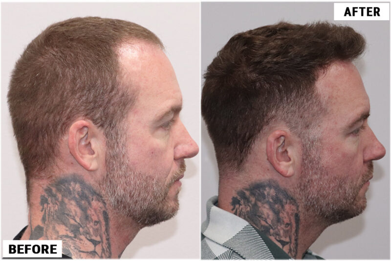 Hair transplant 1661 grafts FUE right #2