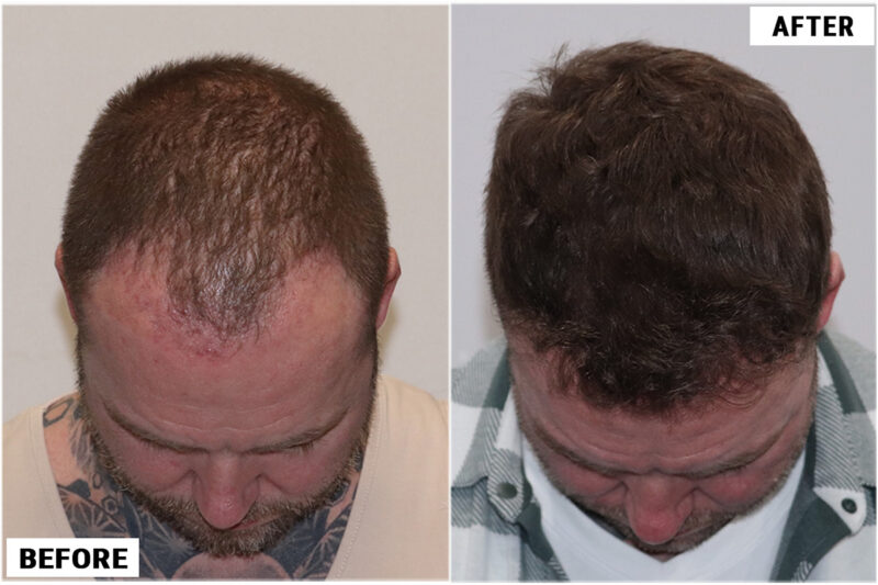 Hair transplant 1661 grafts FUE top