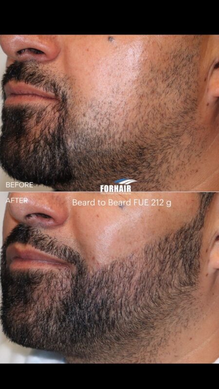 FUE beard 420g left