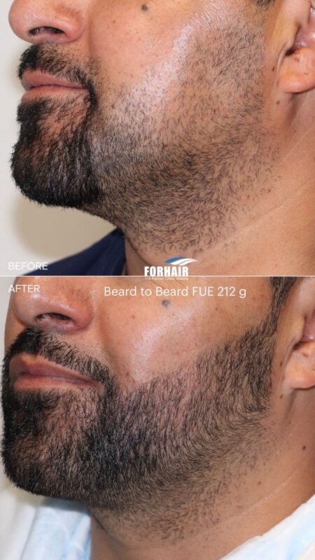 FUE beard 420g left 2