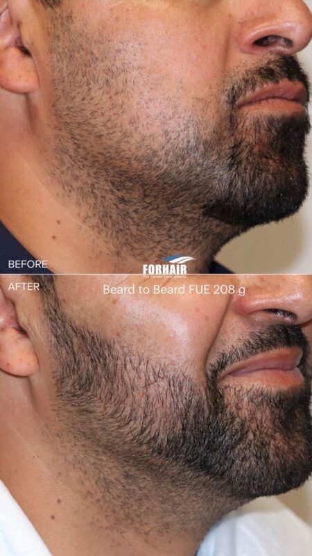 FUE beard 420g right