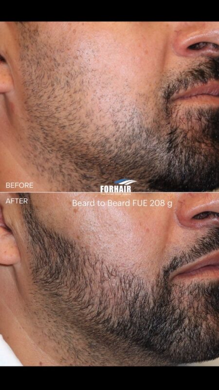 FUE beard 420g right 2