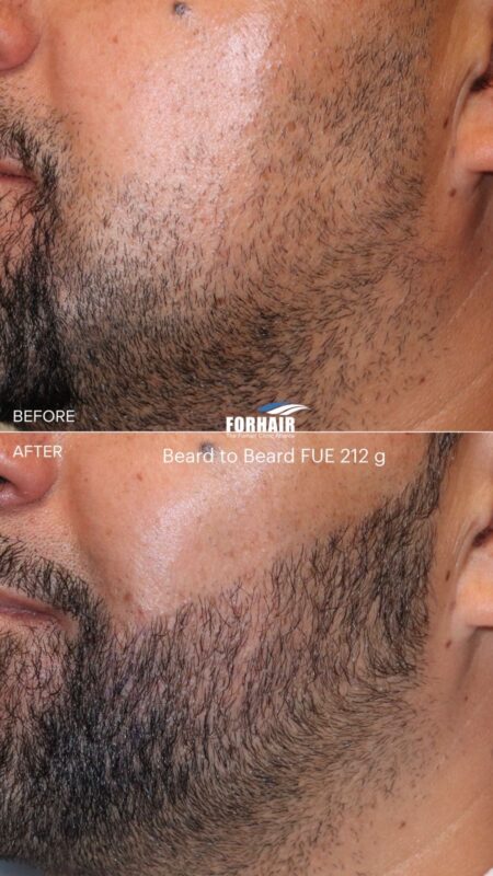 FUE beard 420g left close