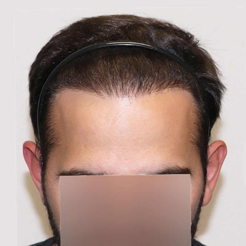 FUE plug removal #4 front