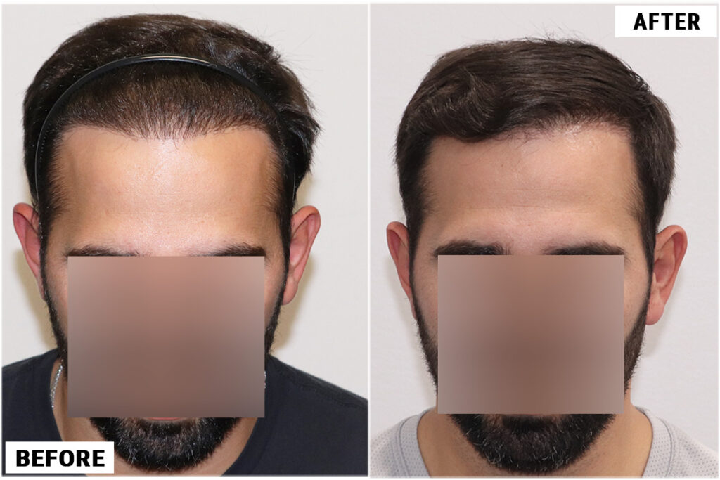 FUE plug removal #4 front