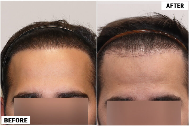 FUE plug removal #4 hairline