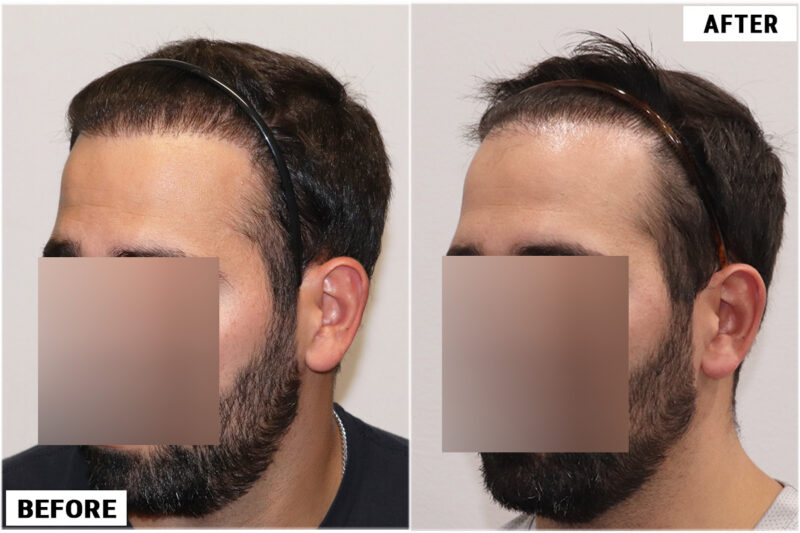 FUE plug removal #4 left