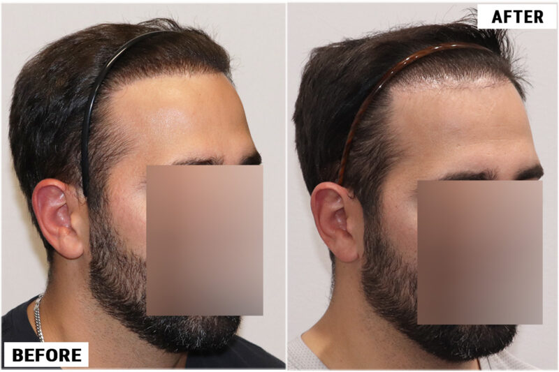FUE plug removal #4 right