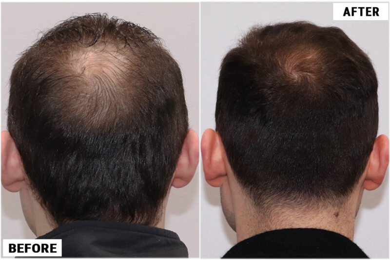 Topical Finasteride 1 crown 1