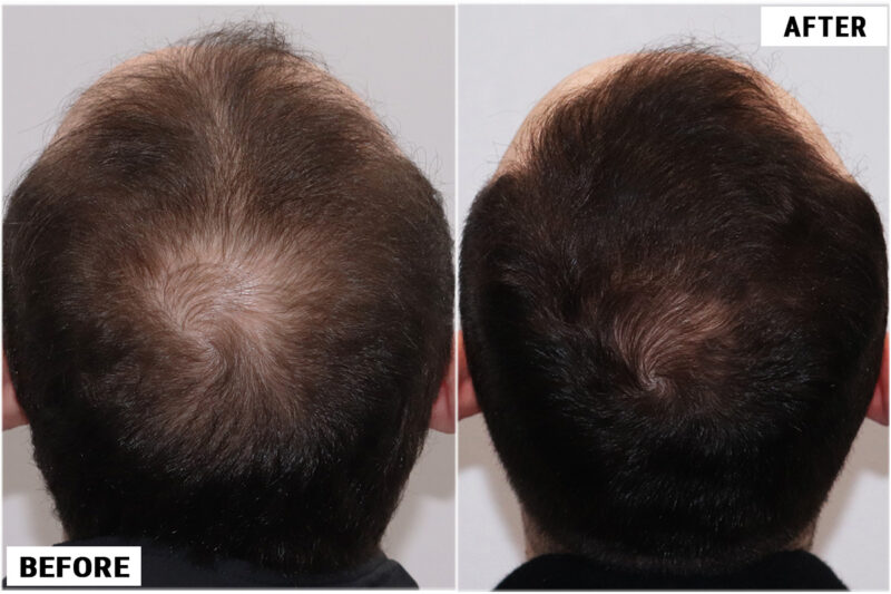 Topical Finasteride 1 crown 2
