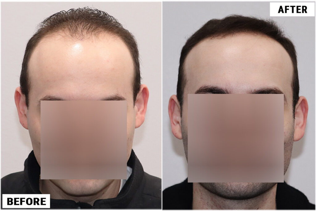 Topical Finasteride 1 front
