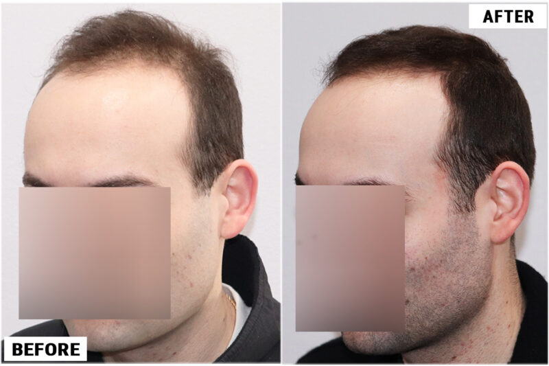 Topical Finasteride 1 left 1