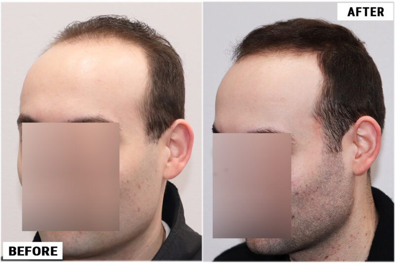 Topical Finasteride 1 left 3