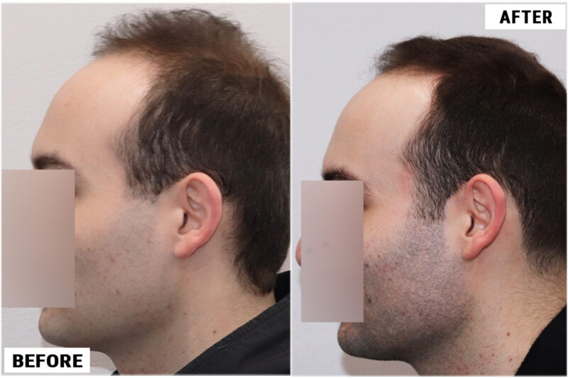 Topical Finasteride 1 left 2