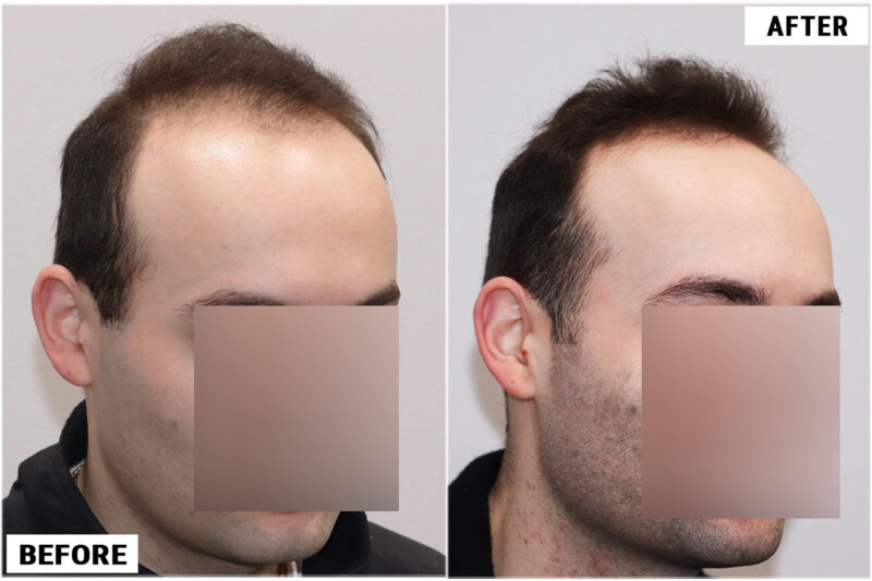 Topical Finasteride 1 right 1