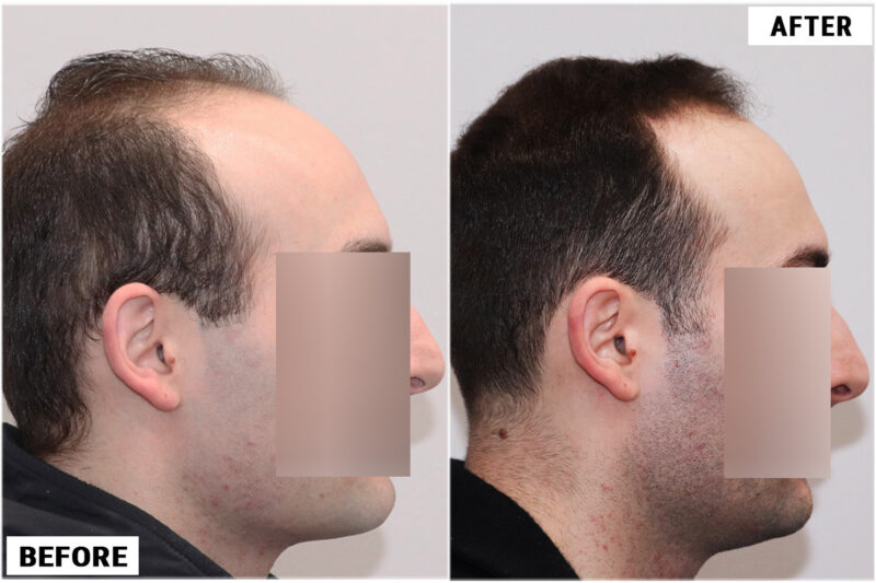 Topical Finasteride 1 left 2