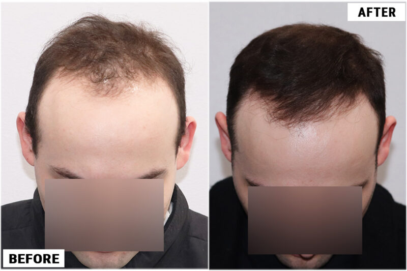 Topical Finasteride 1 top 1
