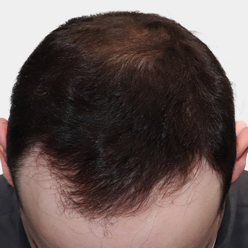Topical Finasteride 1 front