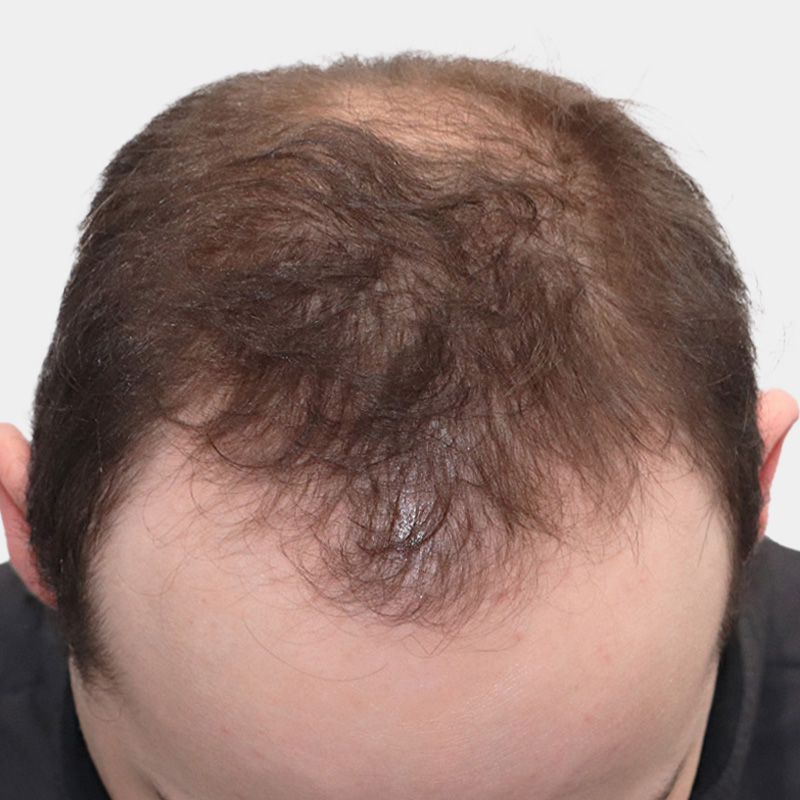 Topical Finasteride 1 front