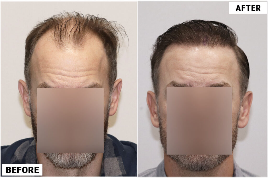 Hair transplant 2885 grafts FUE front