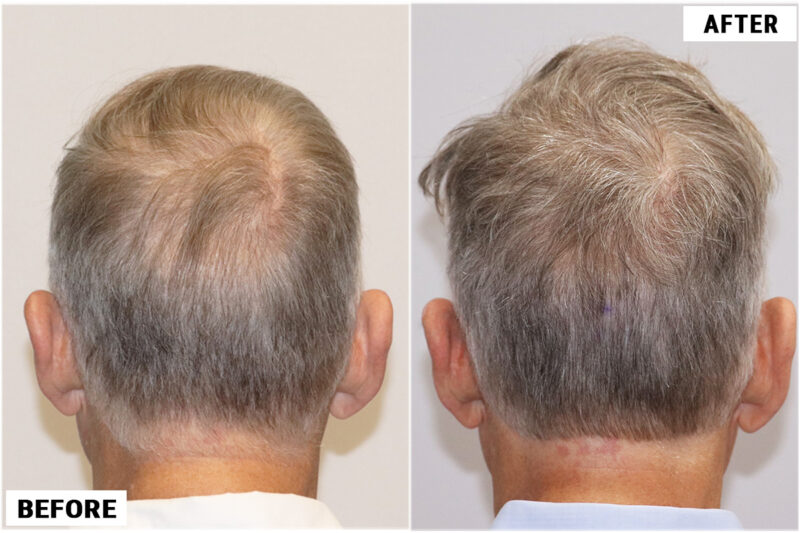 FUE 1212 before after back