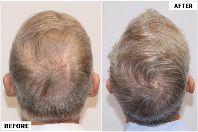 FUE 1012 before after crown