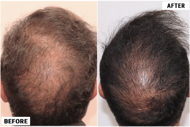 Exoxomes before & after march crown view