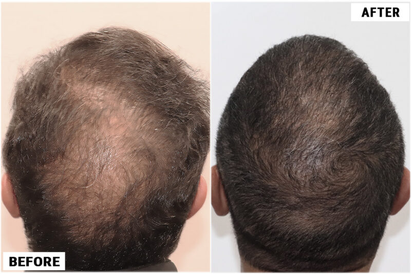 Exoxomes before & after crown