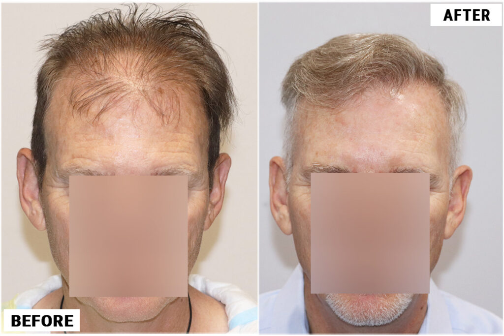 FUE 1212 before after front