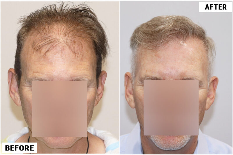 FUE 1212 before after front