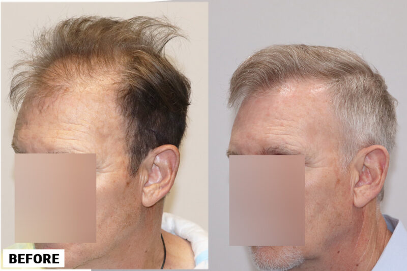 FUE 1212 before after left