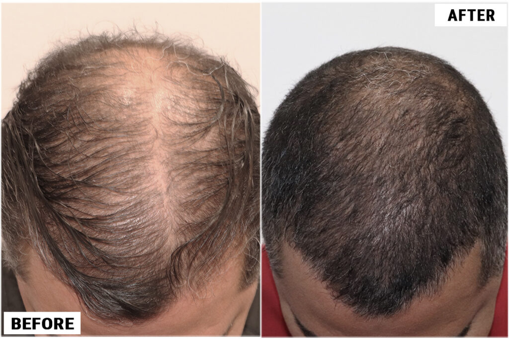 Exoxomes before & after may top view