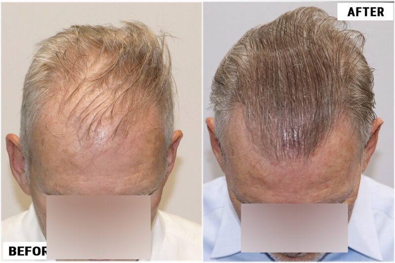 FUE 1212 before after top (wet)