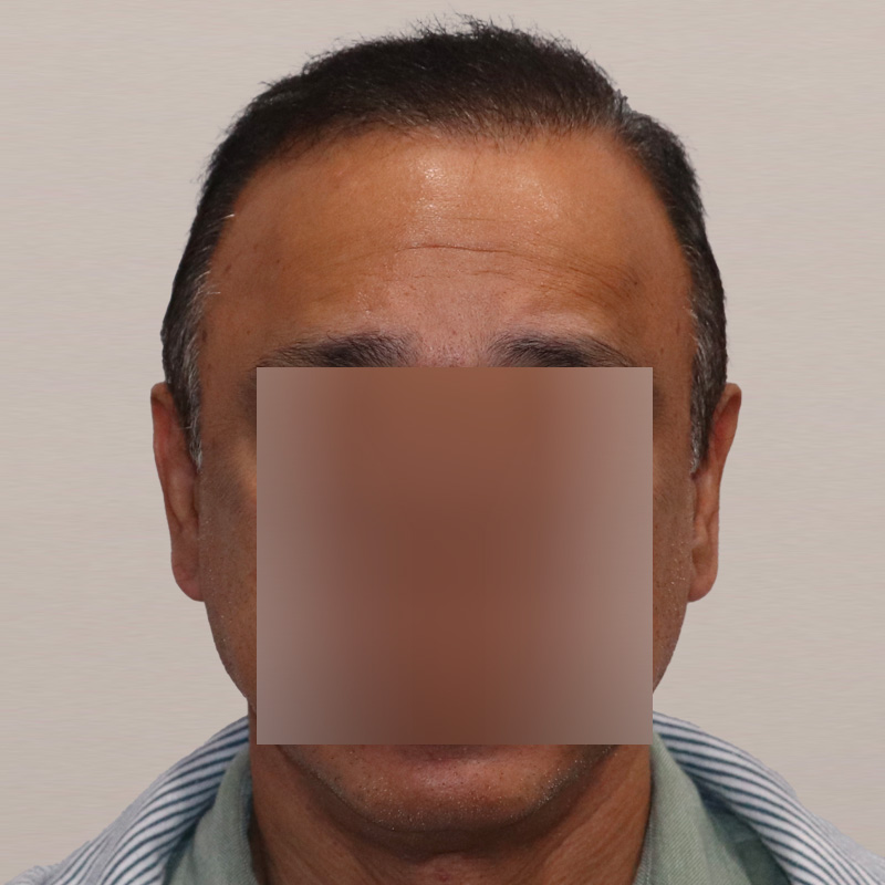 FUE 3241 grafts - before & after front dry