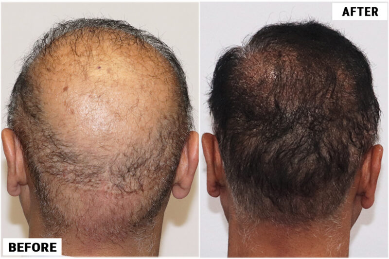 FUE 3241 grafts - before & after 2nd procedure donor