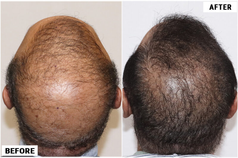 FUE 3241 grafts - before & after crown