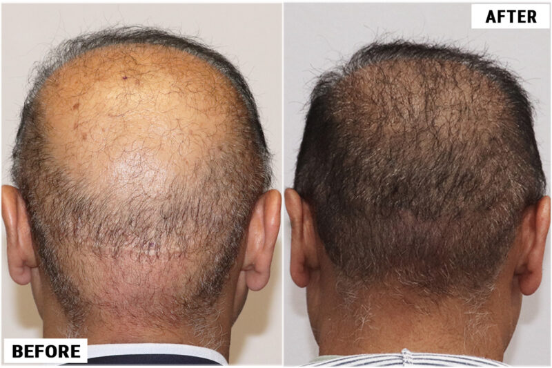 FUE 3241 grafts - before & after back