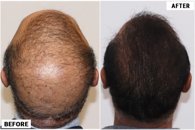 FUE 3241 grafts - before & after 2nd procedure crown