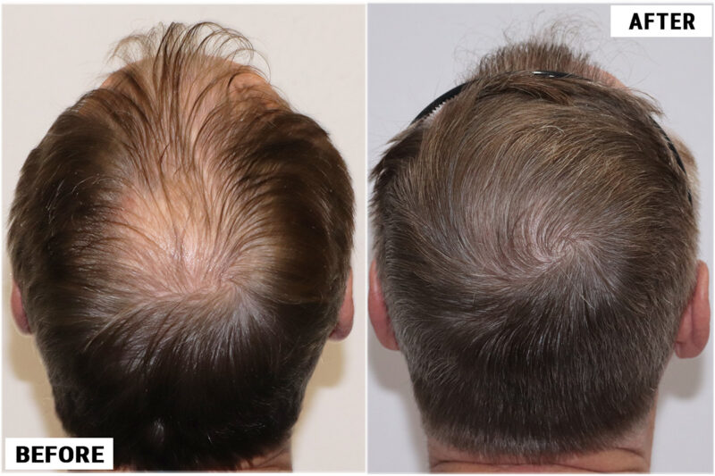 Before & after 1989 grafts FUE crown wet