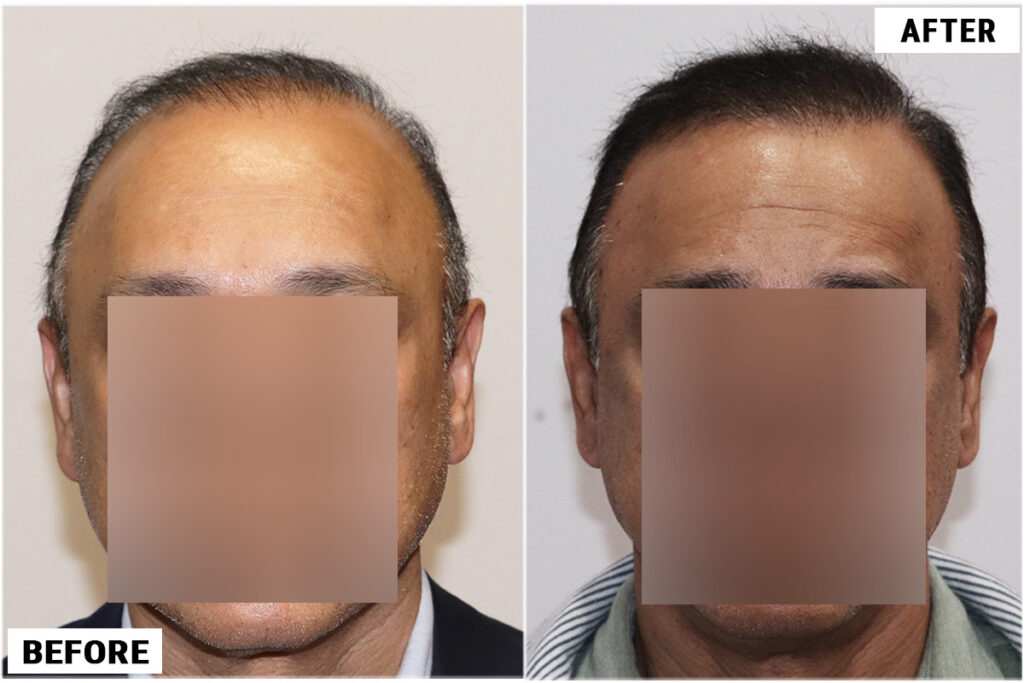 FUE 3241 grafts - before & after front dry