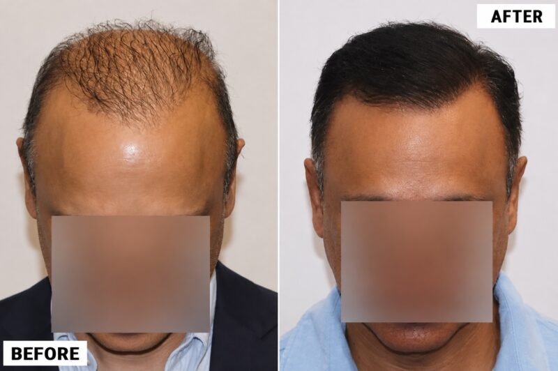 FUE 3241 grafts - before & after 2nd procedure top2