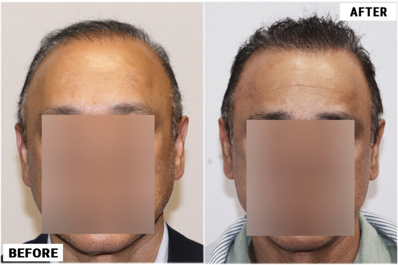 FUE 3241 grafts - before & after front wet