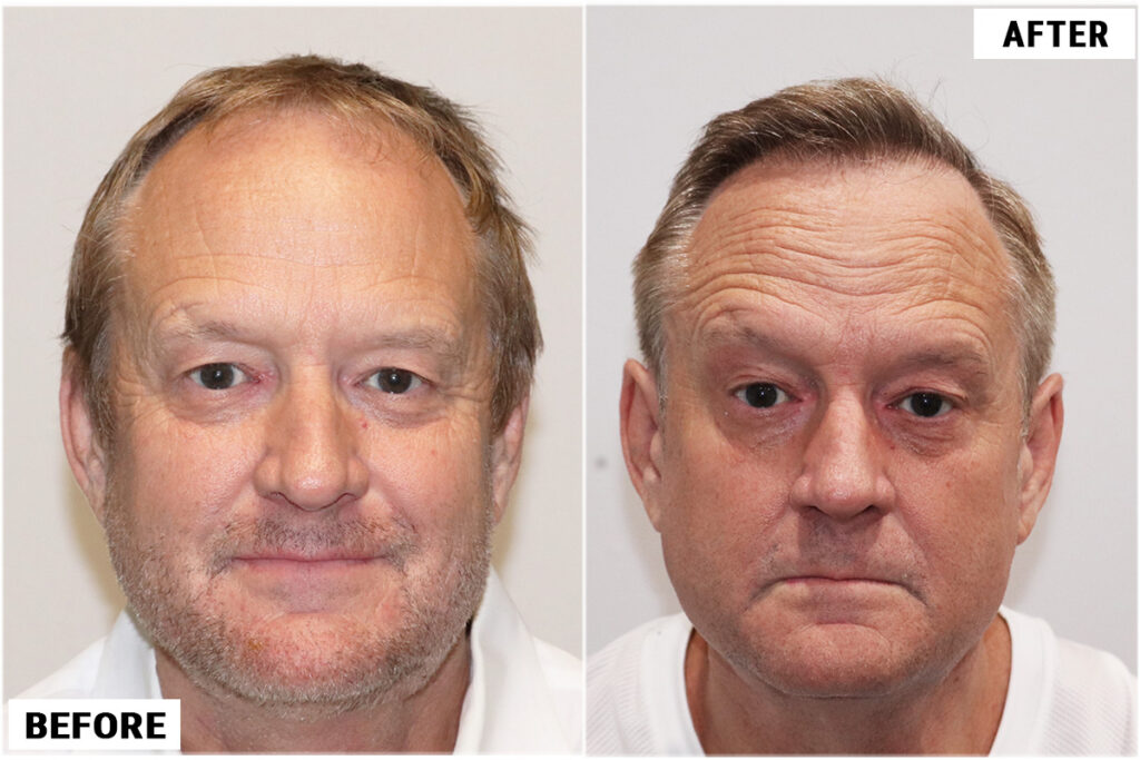 Before & after 1989 grafts FUE front