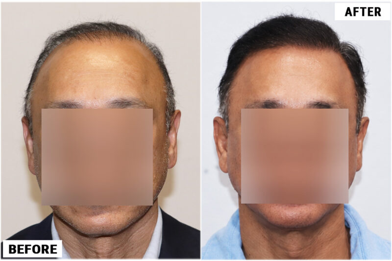 FUE 3241 grafts - before & after 2nd procedure back dry