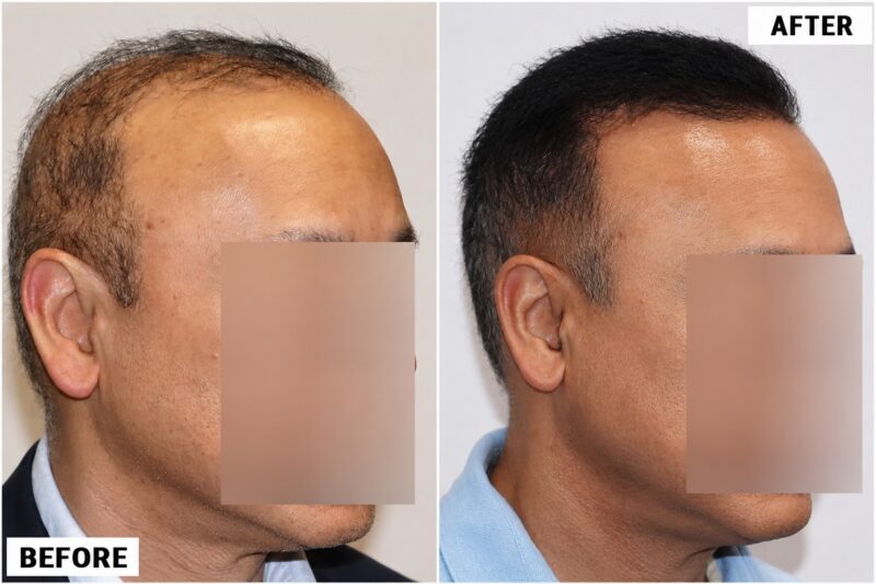 FUE 3241 grafts - before & after 2nd procedure right 