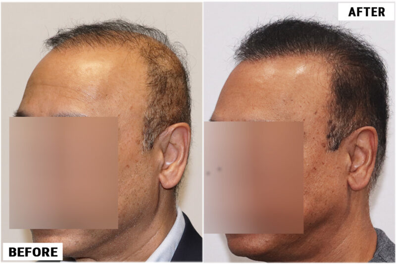 FUE 3241 grafts - before & after 2nd procedure left