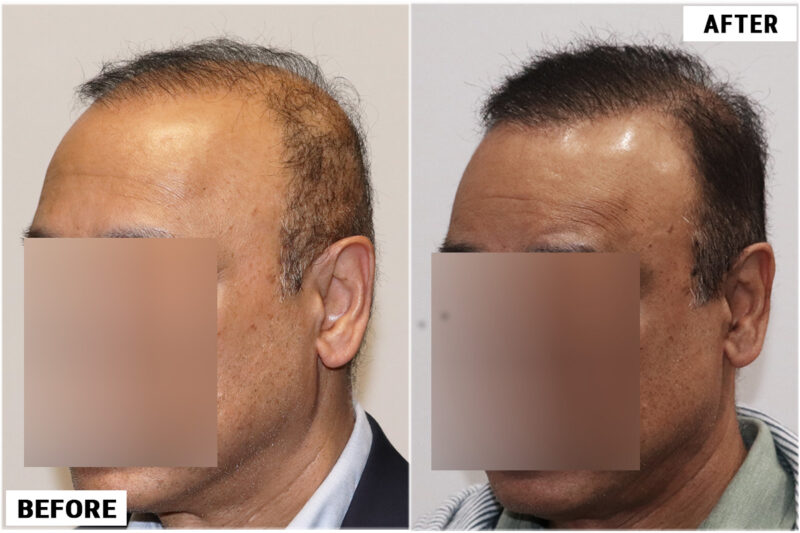 FUE 3241 grafts - before & after right