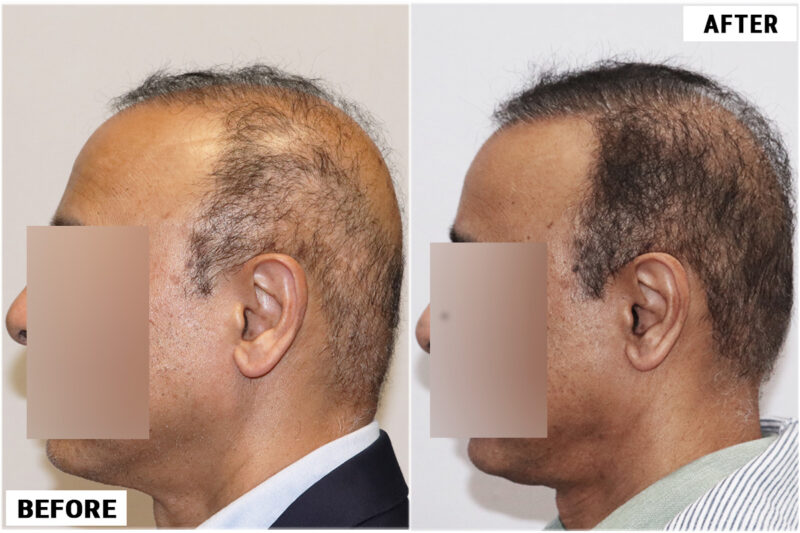 FUE 3241 grafts - before & after right #2
