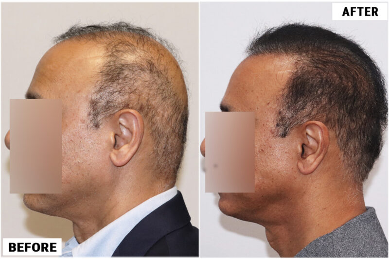 FUE 3241 grafts - before & after 2nd procedure left 2